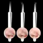 Facial Blackhead Remover Tweezers - Image 13