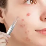 Facial Blackhead Remover Tweezers - Image 2